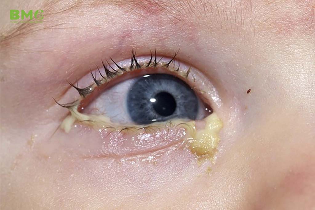 tiết dịch mắt trẻ sơ sinh